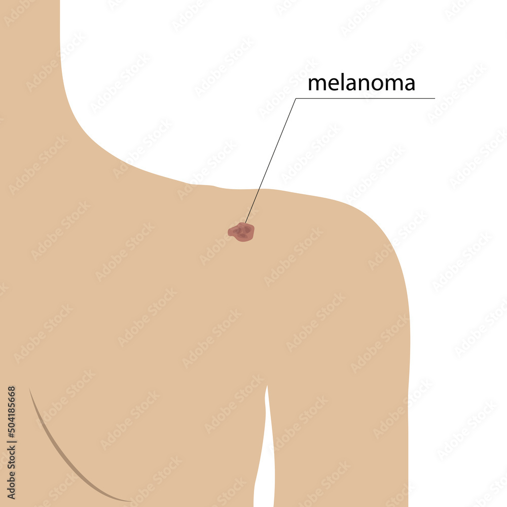 Schematic image of melanoma on the skin, changes in the shape and color of moles on the body Schematic image of melanoma on the skin, changes in the shape and color of moles on the body
