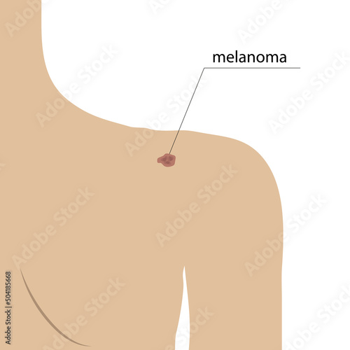 Schematic image of melanoma on the skin, changes in the shape and color of moles on the body