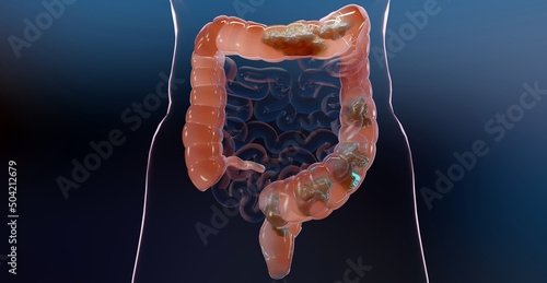 3d illustration of human digestive system anatomy, concept of the intestine, laxative, traitement of constipation, 3d render	 photo