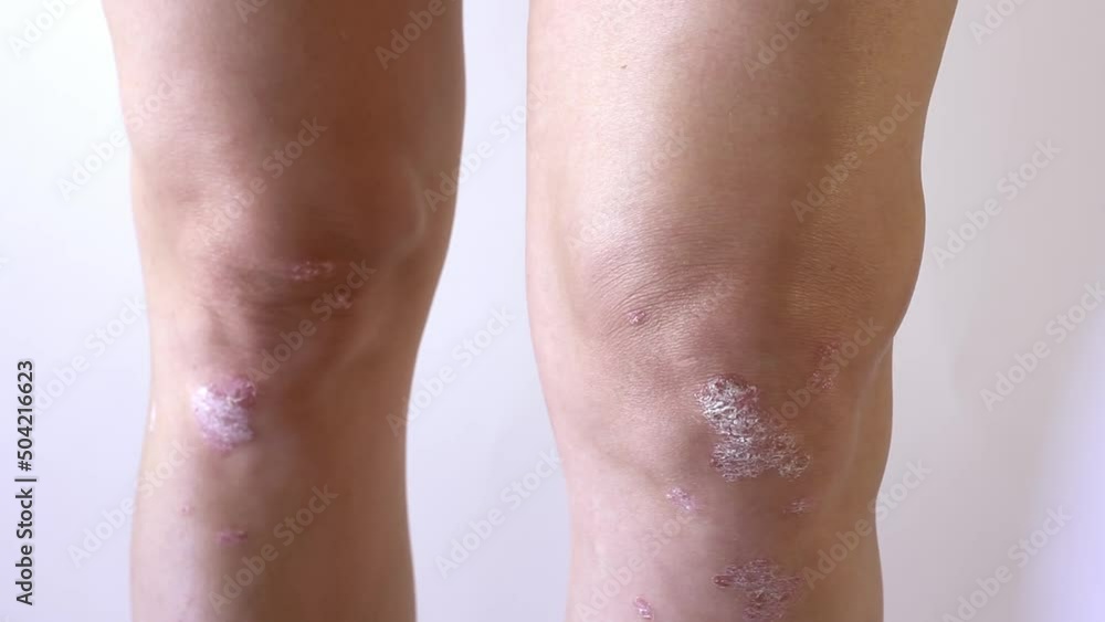 Knee joint effusion , water on the knee.Acute psoriatic arthritis