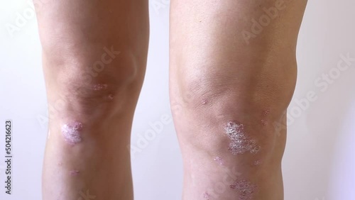 Knee joint effusion , water on the knee.Acute psoriatic arthritis, arthrosis ,meniscus injury.Excess synovial fluid in and around the left knee joint