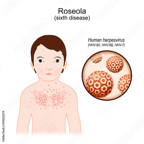 Roseola. sixth disease. infectious disease. human herpes viruses.