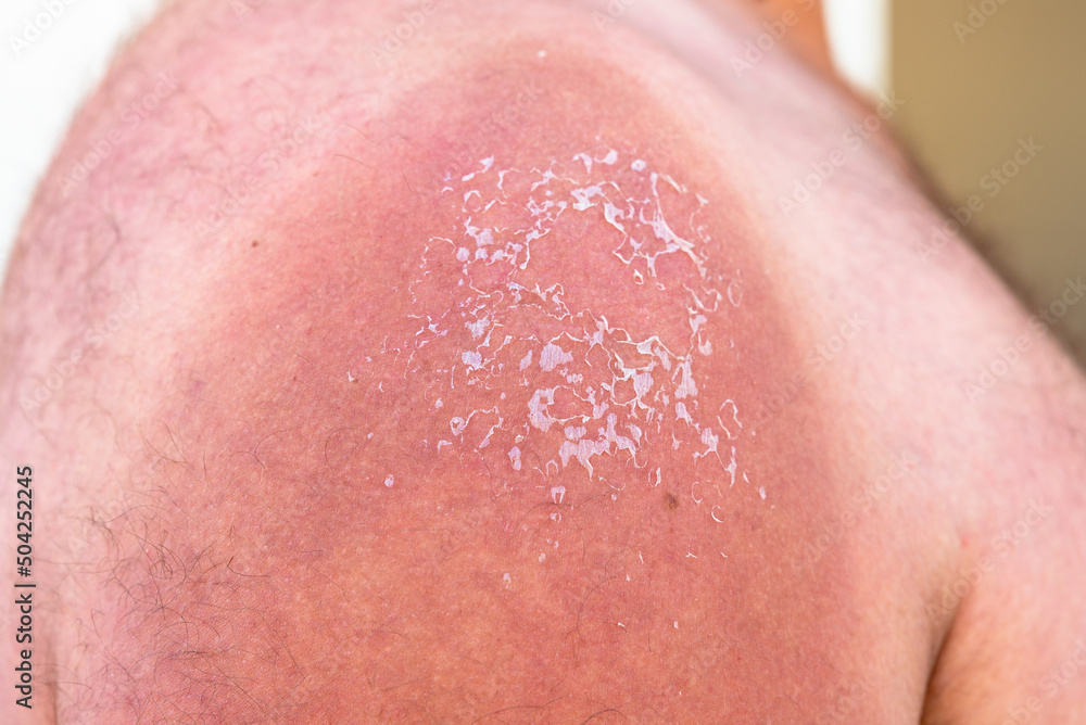 Fototapeta premium fresh little sunburn bubbles on a man's shoulder. use uv protection