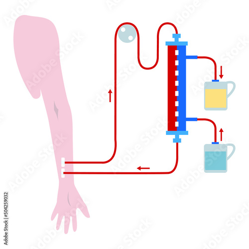 Renal hemodialysis scheme. Conditional chart. medical illustration