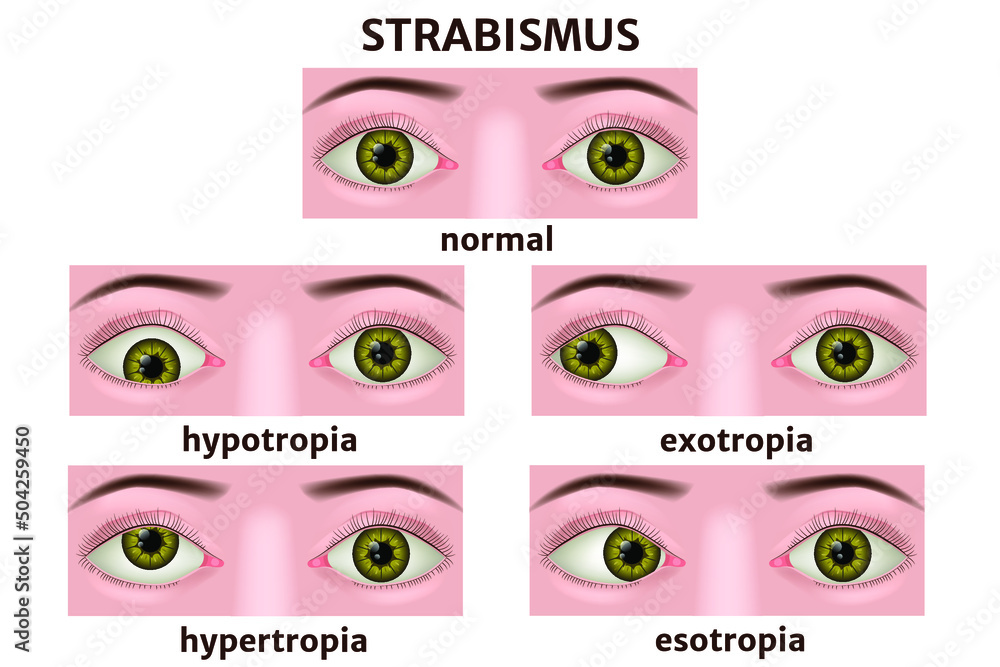 Varieties of strabismus. Eye disease infographic. Medical poster