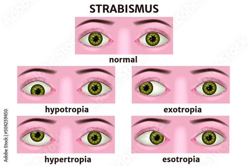 Varieties of strabismus. Eye disease infographic. Medical poster. Vector illustration