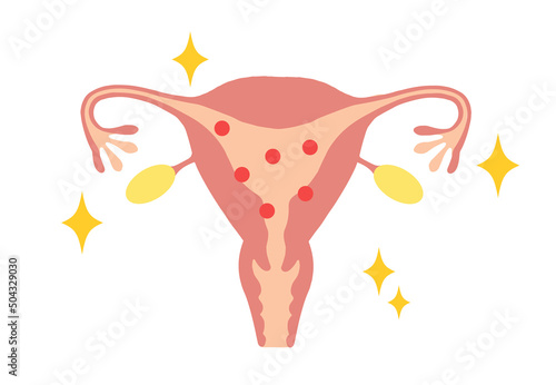 Illustration of a young woman's uterus with high estrogen levels.