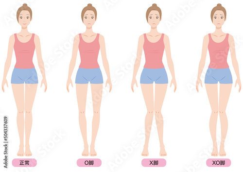 O脚・X脚・XO脚の女性