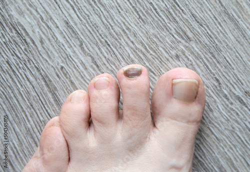 Close up view of woman foot with black toenail caused by long walk. Medical condition and pedicure problem concept. photo