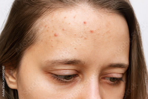 Close up of pimples on a forehead. Cropped shot of a young woman's face with acne problem. Allergies, rash, hormonal changes. Problem skin, care and beauty concept. Dermatology, cosmetology photo