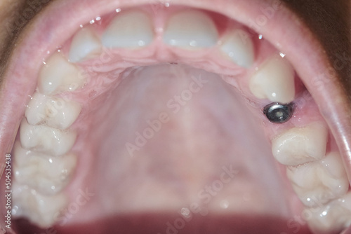Close up of a real mouth with dental molar screw implant.