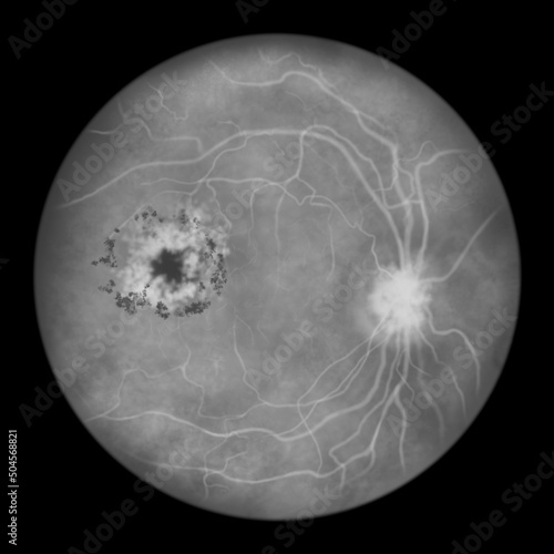 Diabetic retinopathy, ophthalmoscopic diagnosis, illustration