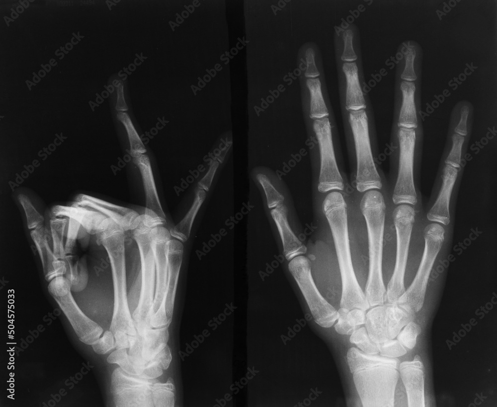 Radiography of child's hand Radiography of child's hand