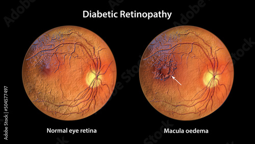Proliferative diabetic retinopathy, illustration photo