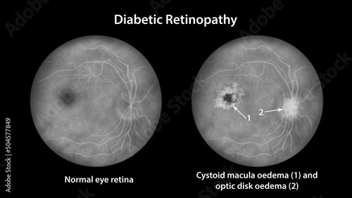 Proliferative diabetic retinopathy, illustration