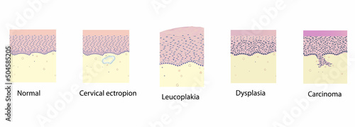 morphology of cervix pathology under a microscope, illustration, vector photo