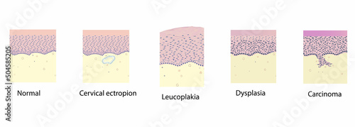 morphology of cervix pathology under a microscope, illustration, vector