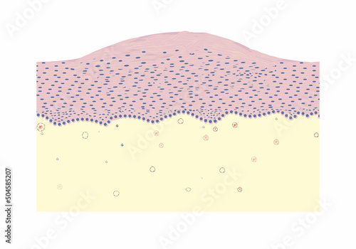 morphology of leucoplakia under a microscope, illustration, vector