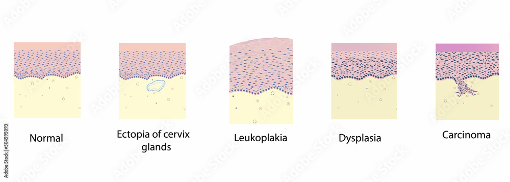 morphology of cervix pathology under a microscope, illustration, vector