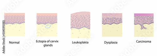 morphology of cervix pathology under a microscope, illustration, vector