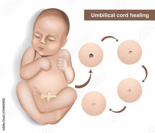Umbilical cord care in newborns. Newborn umbilical cord stump falling off cycle. Dried stump of an umbilical cord of a newborn baby. Umbilical cord healing