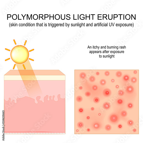 Polymorphic light eruption.