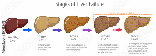 Stages liver failure, cancer, transplant disease steps. Annotated, explanations. Progression, healthy normal liver, fatty fibrosis, cirrhosis, ESLD. medical, human organs. Vector illustration