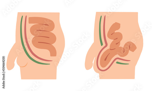 Male illness inguinal hernia illustration