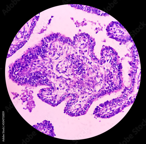 Fallopian tube(biopsy): features of hydrosalpinx(Blocked Fallopian Tube), microscopic 40x view, no malignant cell seen. photo