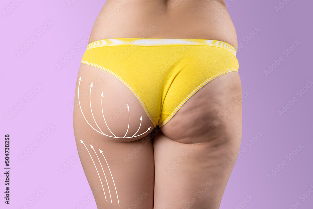 Overweight woman with fat cellulite legs and buttocks, before after concept, obesity female body with painted surgical lines and arrows - obrazy, fototapety, plakaty 