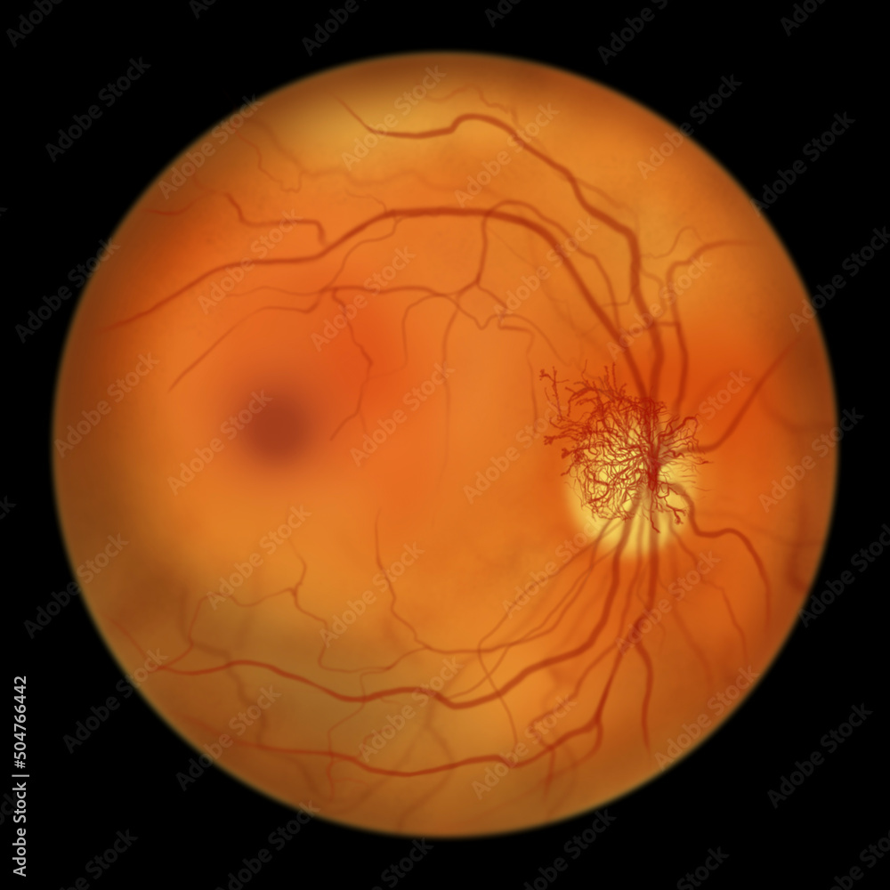 Diabetic retinopathy, ophthalmoscopic diagnosis, illustration Diabetic retinopathy, ophthalmoscopic diagnosis, illustration