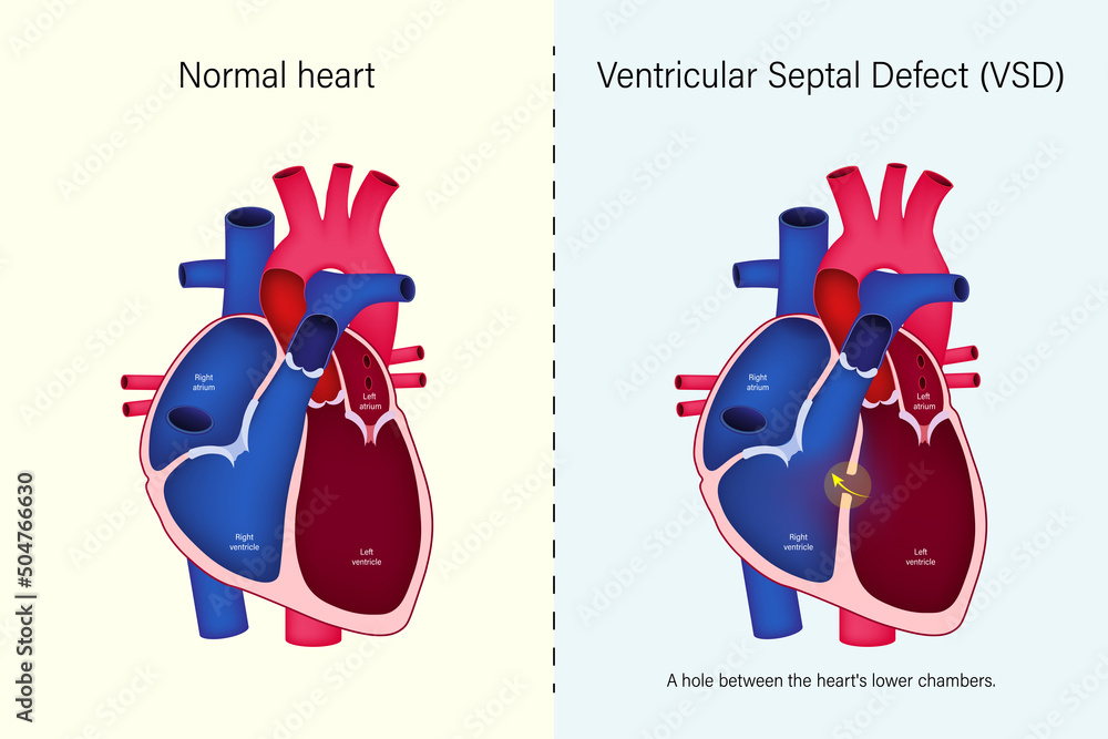The difference of normal heart and ventricular septal defect (VSD) vector. Congenital heart defect. - obrazy, fototapety, plakaty 