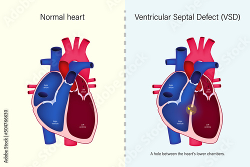 The difference of normal heart and ventricular septal defect (VSD) vector. Congenital heart defect. photo
