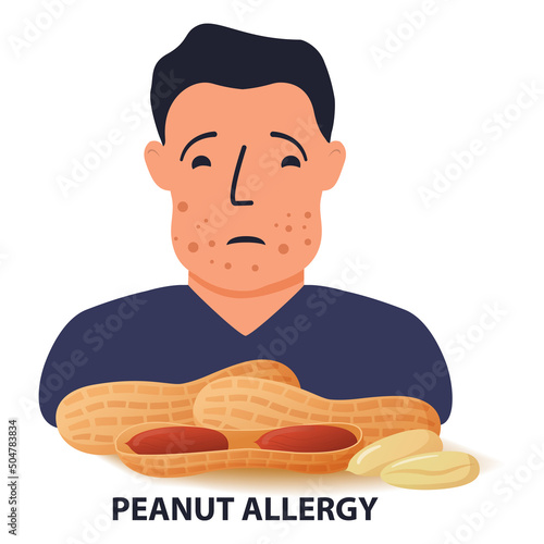 Nut allergy symptoms problem .Swollen man character.Allergic reaction to peanuts.Flat illustration vector.Isolated on a white background.