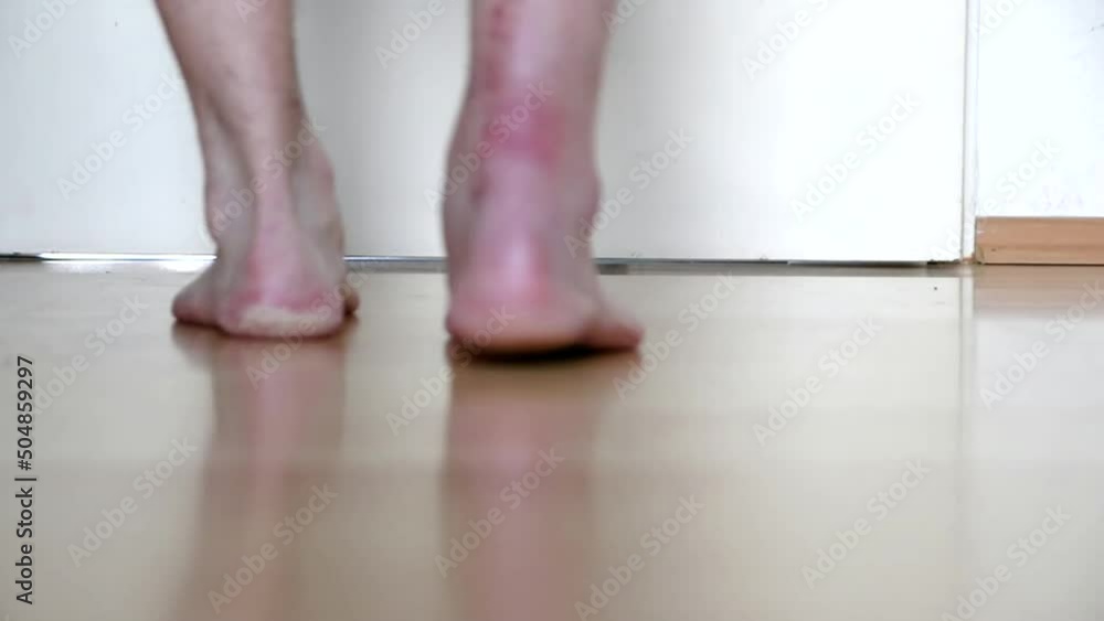 European man first steps after Achilles tendon rupture operation shows wound suture in the hospital showing stitches and operation transection walks barefoot with pain and partial weight bearing PWB