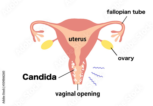 vaginitis Clip art of diseased uterus