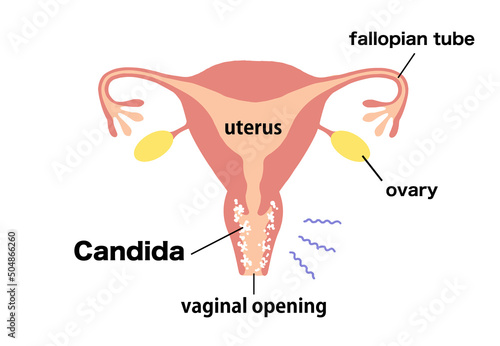 vaginitis Clip art of diseased uterus photo
