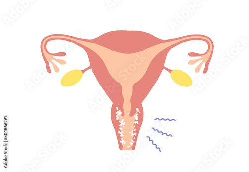 vaginitis Clip art of diseased uterus