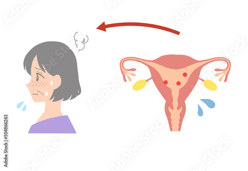 Illustration of the uterus of a low estrogen, perimenopausal middle-aged woman.