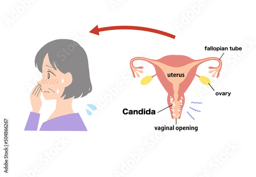 vaginitis Clip art of diseased uterus