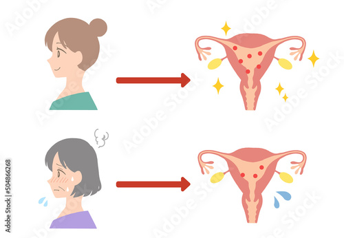Comparative illustration of the uterus of a young woman and a middle-aged woman