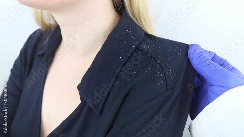 Dandruff on a blond woman shoulder. Side view of a female who has more dandruff flakes on his black shirt. Scalp disease treatment concept. Discomfort from a fungal infection. Head fungus photo