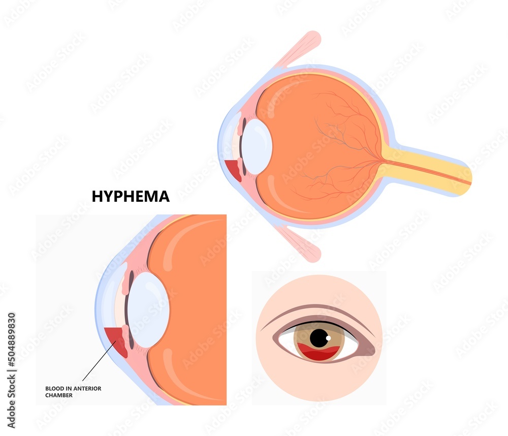 Vetor de Hyphemas red eye bleeding injury and cause pain symptoms