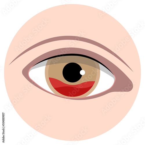 Hyphemas red eye bleeding injury and cause pain symptoms sickle cell exam