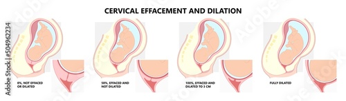 Cervical effaces and Dilatation vagina delivery labor fetal birth giving stage cervix uterine Left vertex mucus plug exam early baby thin