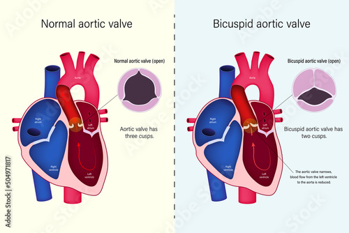 The difference of normal heart valve and bicuspid aortic valve vector. Congenital heart disease. Narrowing of the aortic valve (aortic valve stenosis). photo