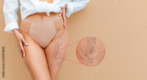 A slender woman in panties and a white shirt poses on a beige background, showing a vascular mesh on her thigh. Close up of legs. Zoomed area of varicose lesion. The concept of varicose veins