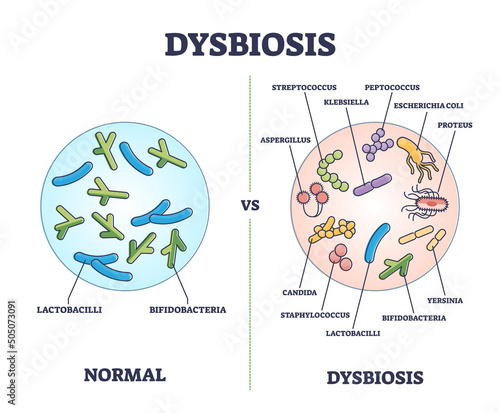 Dysbiosis versus normal gut or tract microflora with bacteria outline diagram. Labeled educational scheme with digestive system differences vector illustration. Microscopic microbe flora comparison.