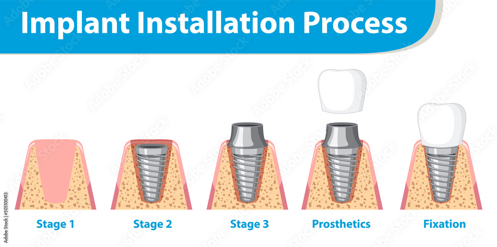 Inplant Process Infographic of human in implant installation process Stock Vector ...