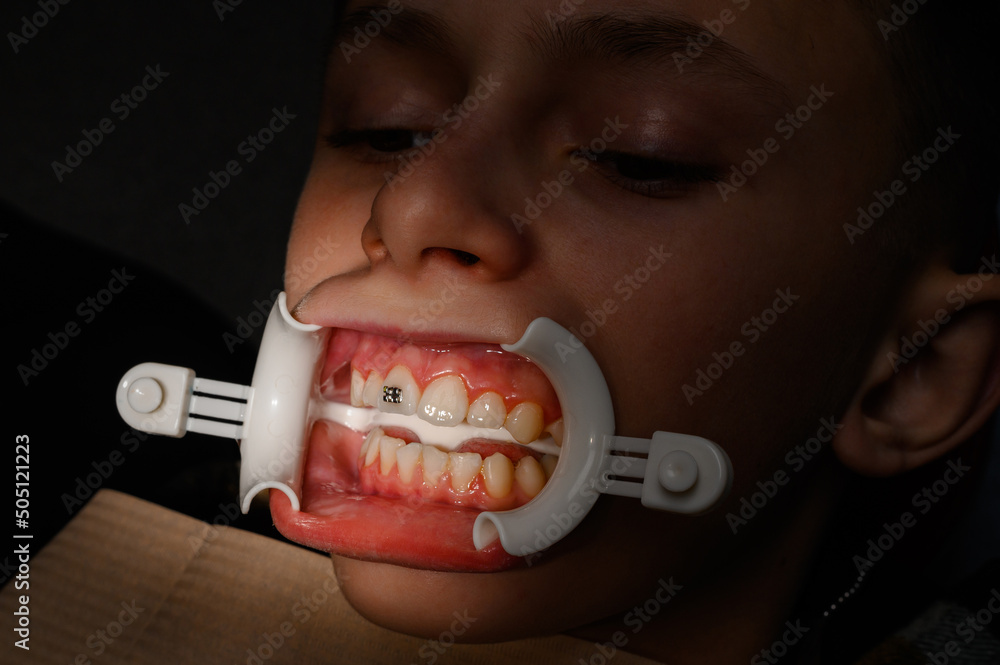 Φωτογραφία The orthodontist installs braces for the student's boyfriend, visits to the dentist, installation of braces, retractor on the patient's lips